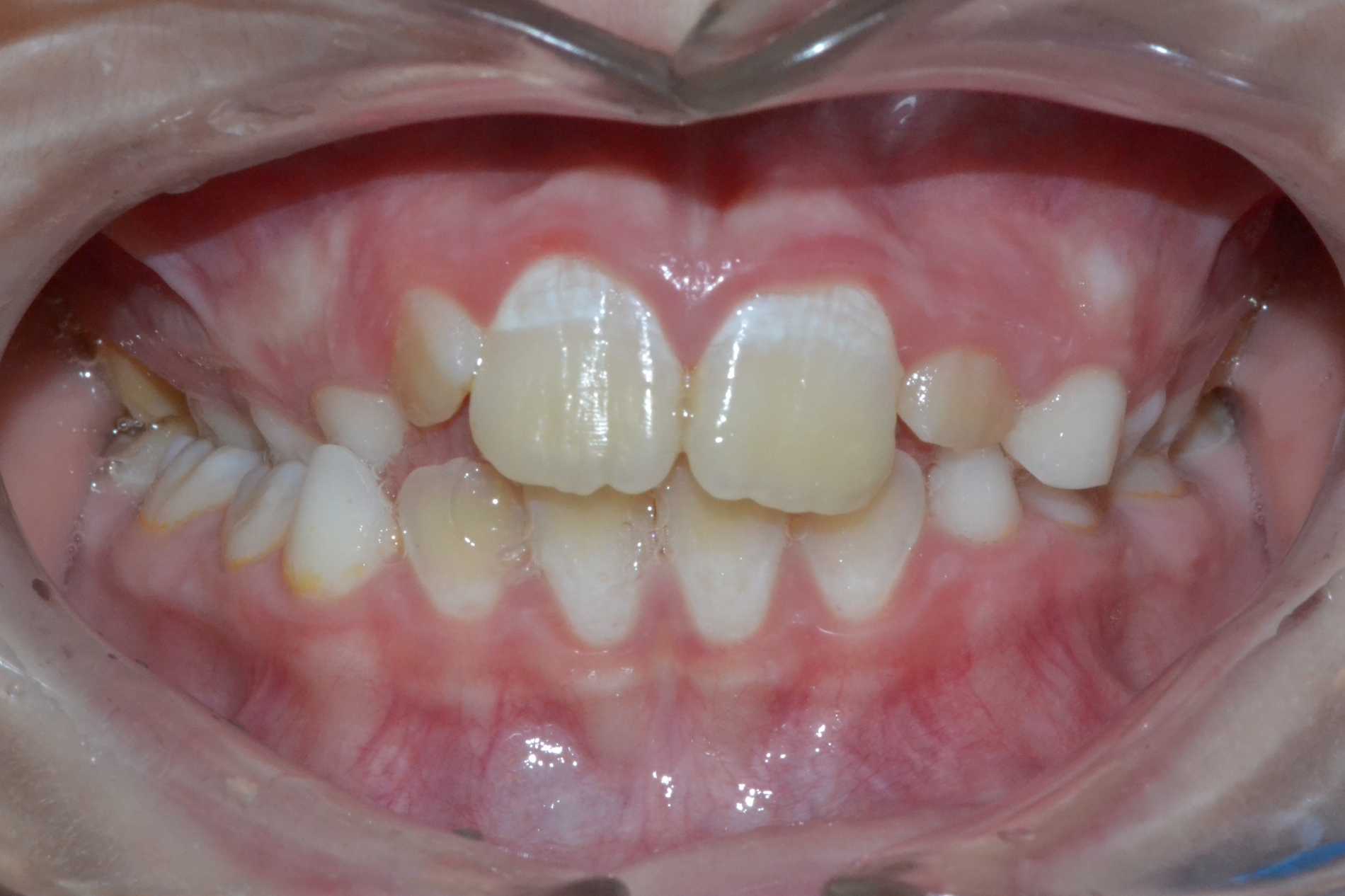 Piccola Paziente - Dentizione Mista Prima
