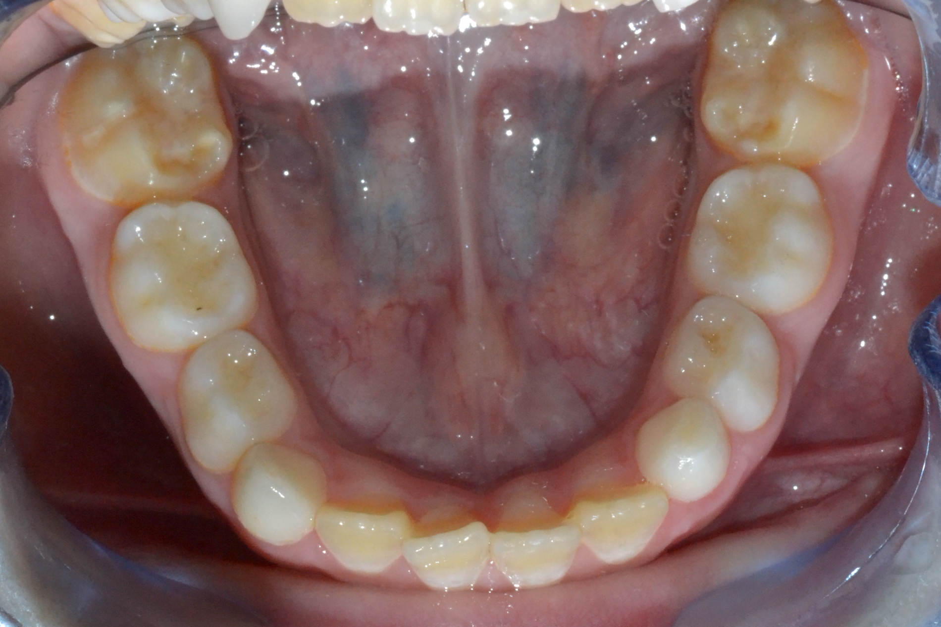 Piccola Paziente - Dentizione Mista Arcata Inferiore