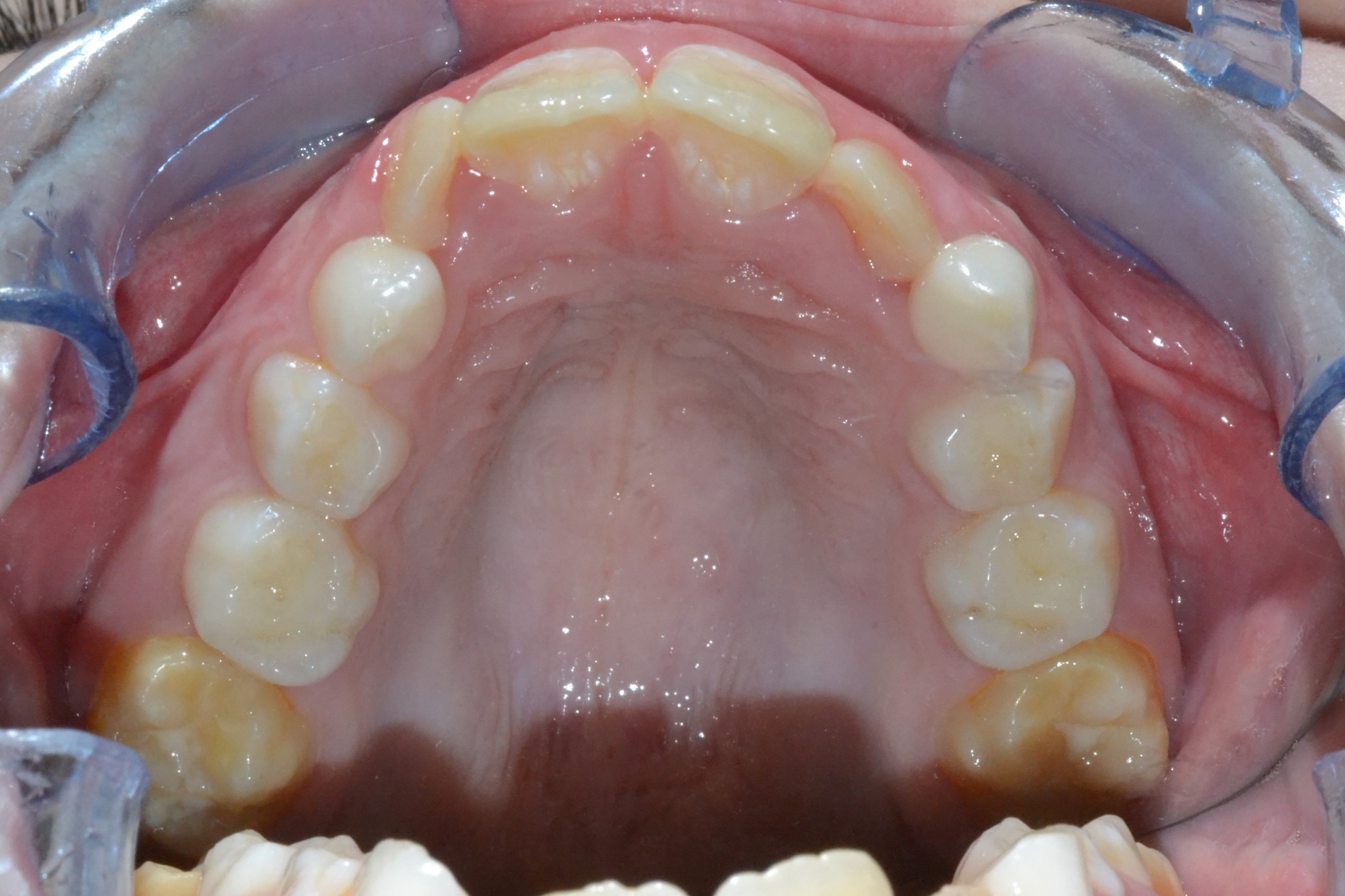 Piccola Paziente - Dentizione Mista Palato Prima