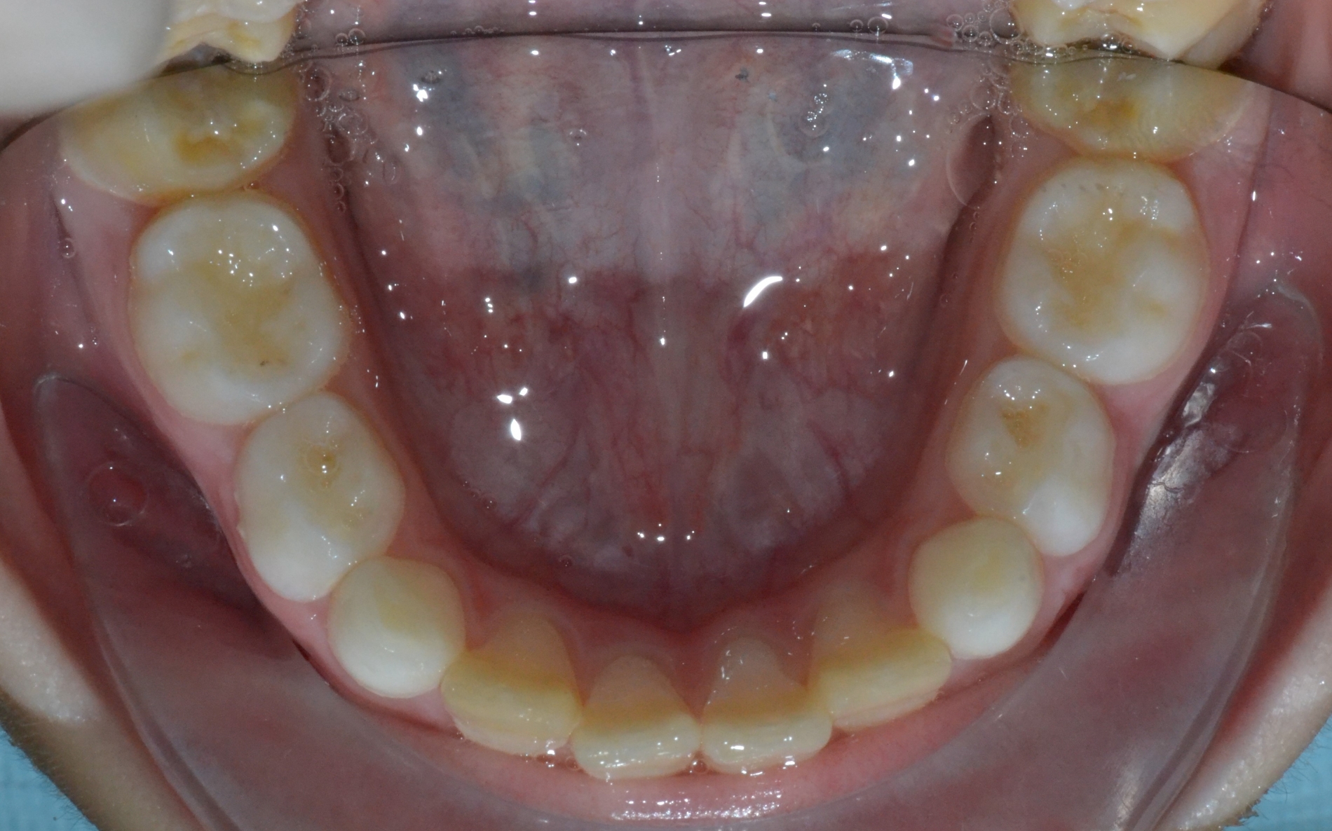 Piccola Paziente - Dentizione Mista Arcata Inferiore Dopo