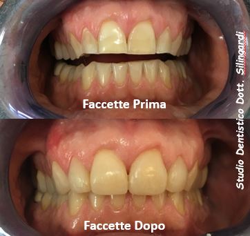 Faccette_new