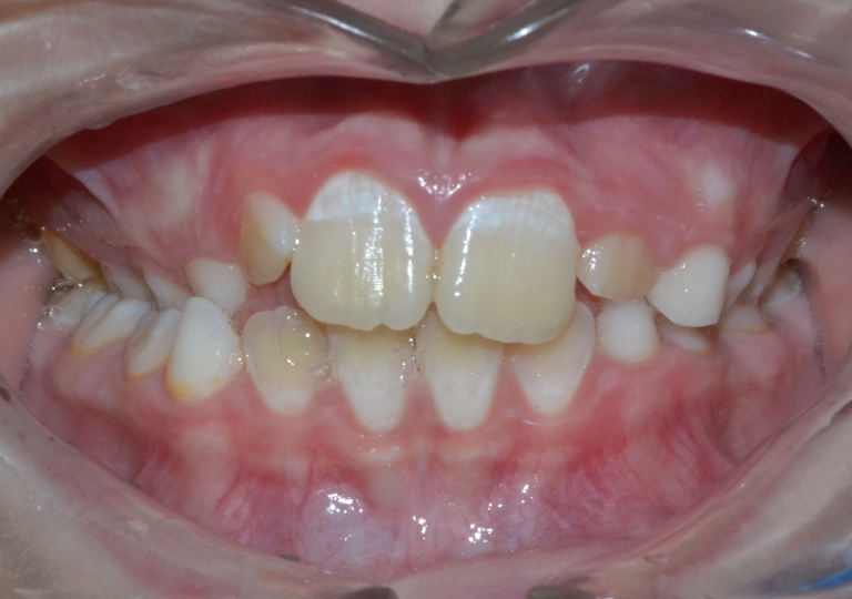 Piccola Paziente - Dentizione Mista Prima
