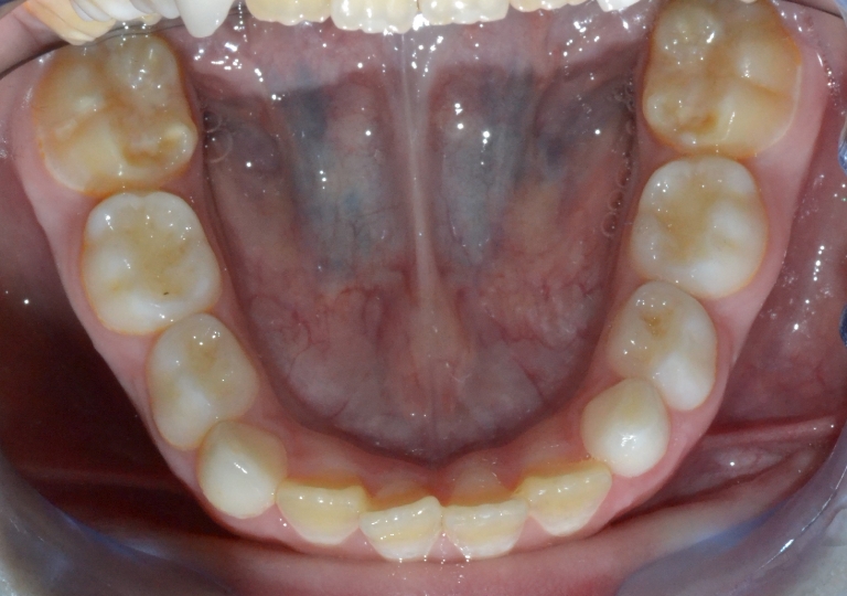 Piccola Paziente - Dentizione Mista Arcata Inferiore