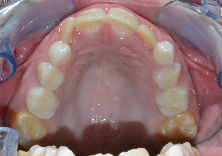 Piccola Paziente - Dentizione Mista Palato Prima