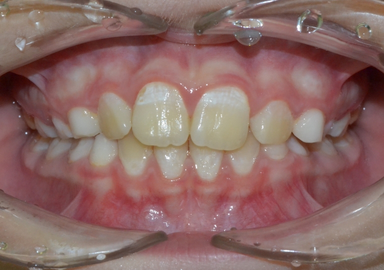 Piccola Paziente - Dentizione Mista Dopo