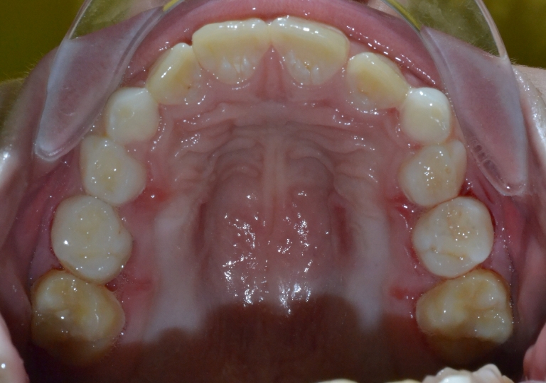 Dentizione Mista Piccola Paziente - Dentizione Mista Palato Dopo