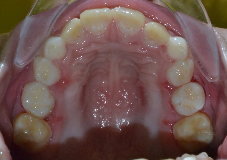 Ortodonzia Dentizione Mista