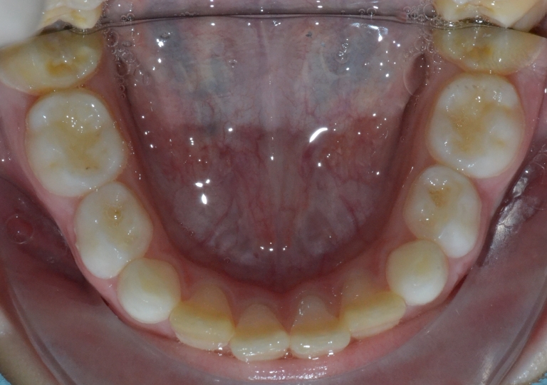 Piccola Paziente - Dentizione Mista Arcata Inferiore Dopo