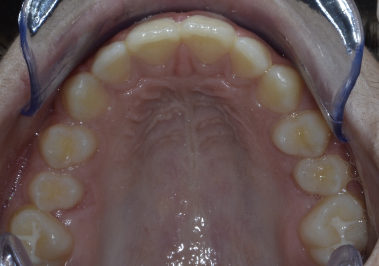 Ortodonzia Paziente Adolescente